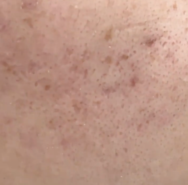 财盈策略 超全面！毛孔粗大拯救指南